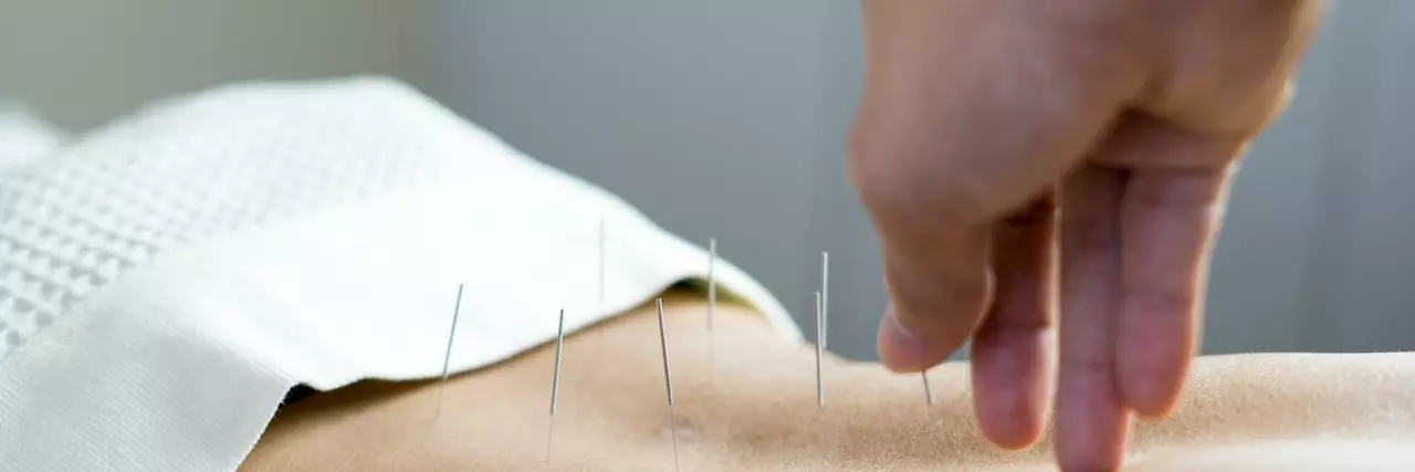 Les avantages de l'acupuncture pour les états spastiques des muscles